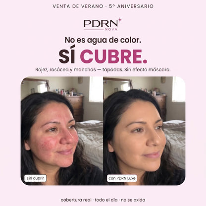 PDRN Luxe sí cubre — rojez, rosácea y manchas tapadas (antes y con PDRN Luxe)