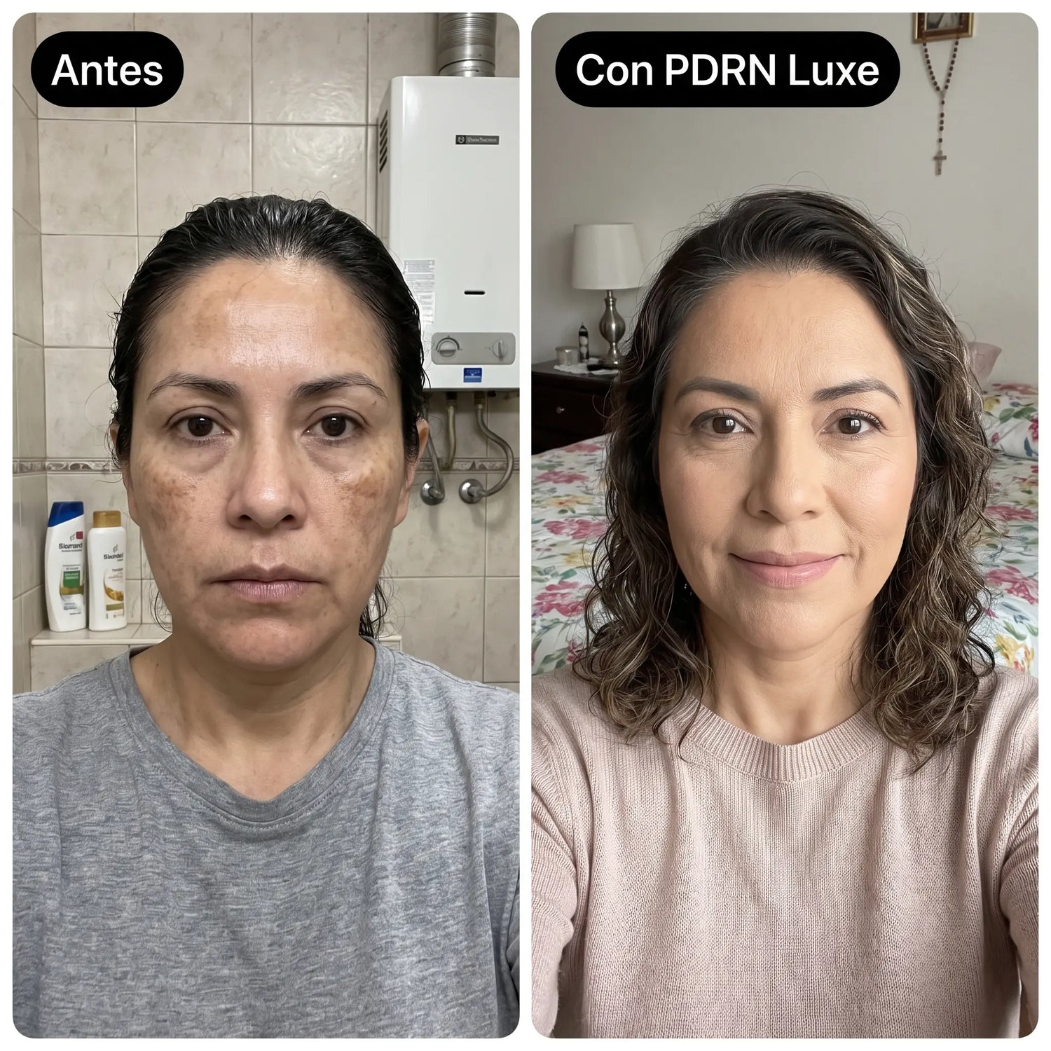 Antes y después de manchas con PDRN Luxe