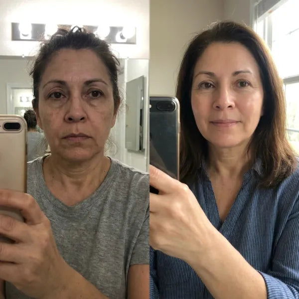 Antes y después · piel · 90 días